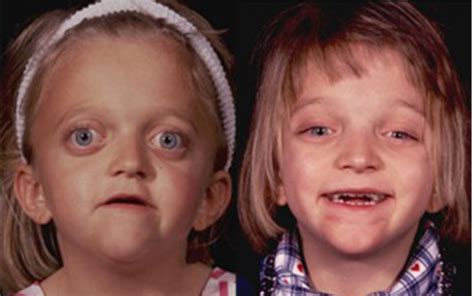crouzon syndrome results in lower jaw figgerits answers|Crouzon syndrome: Genetic and intervention review .